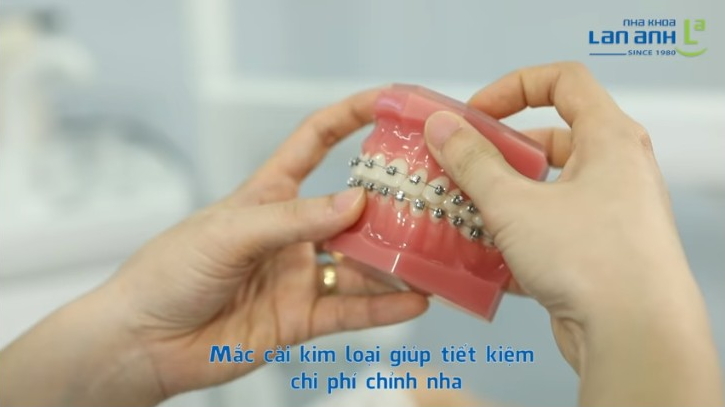 Orthodontic treatment at Lan Anh Dental