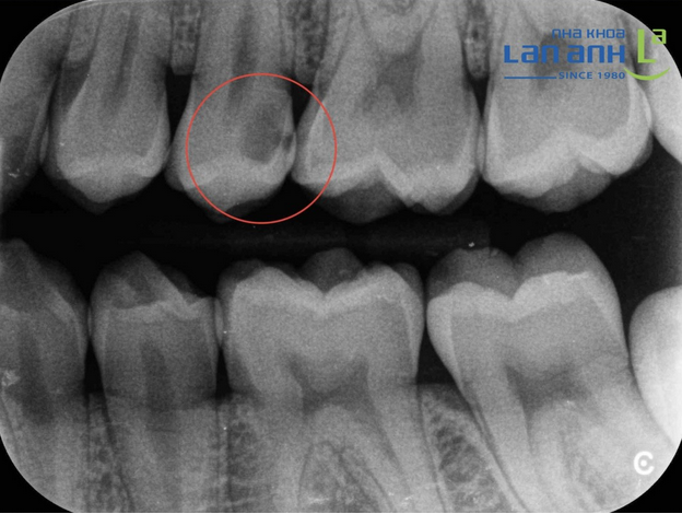 Is Tooth Decay Easily Detected With The Naked Eye?