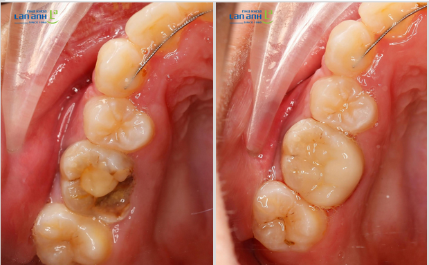 What Matters Should Be Noted When Filling Children's Teeth