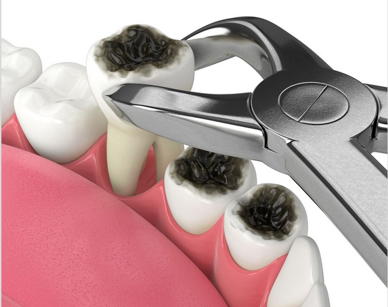 Is tooth extraction an easy or difficult technique?