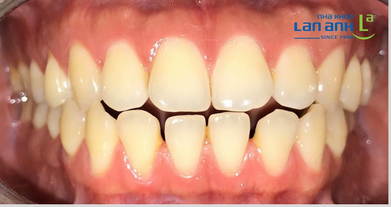 Some Cases of Invisalign treatment