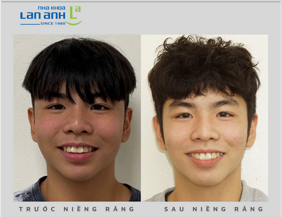 What Do You Care About When Your Children Have Orthodontic Treatment?