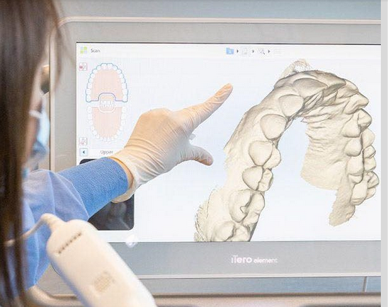 What is Invisalign Smileview Simulator?