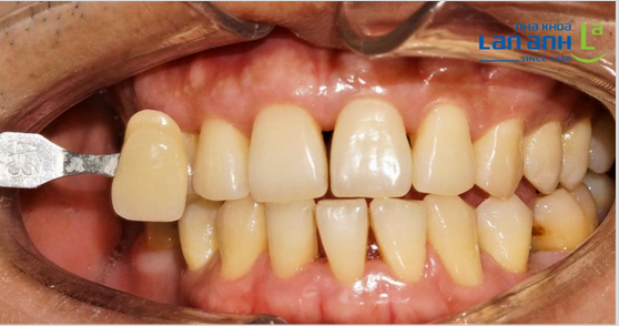 Teeth Whitening With Philips Zoom Whitespeed, Transform Tooth Shade from A3 To B1 In Just 60 Minutes