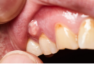 What Should You Do When Your Teeth Are Infected and Painful?