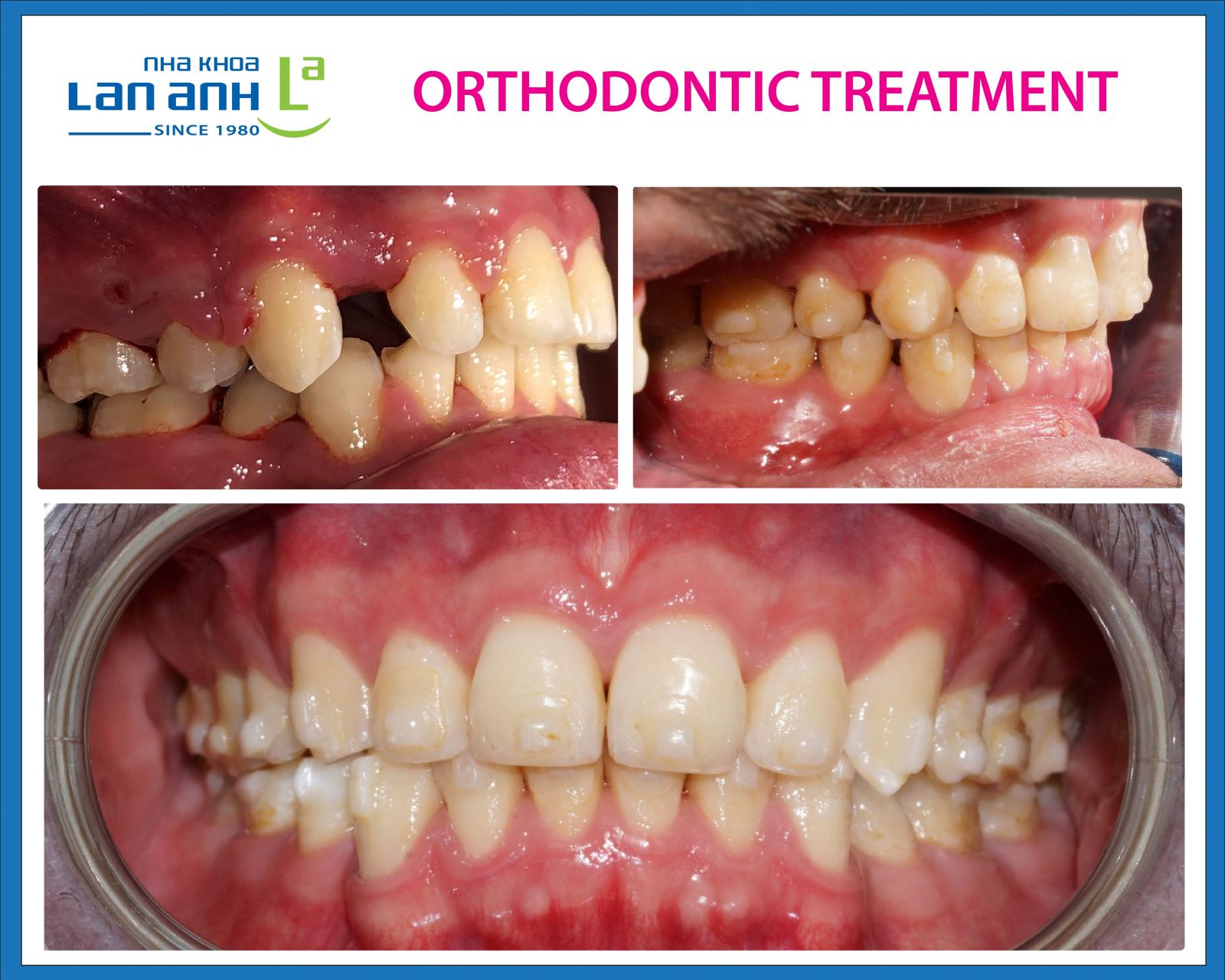 Orthodontic Treatment