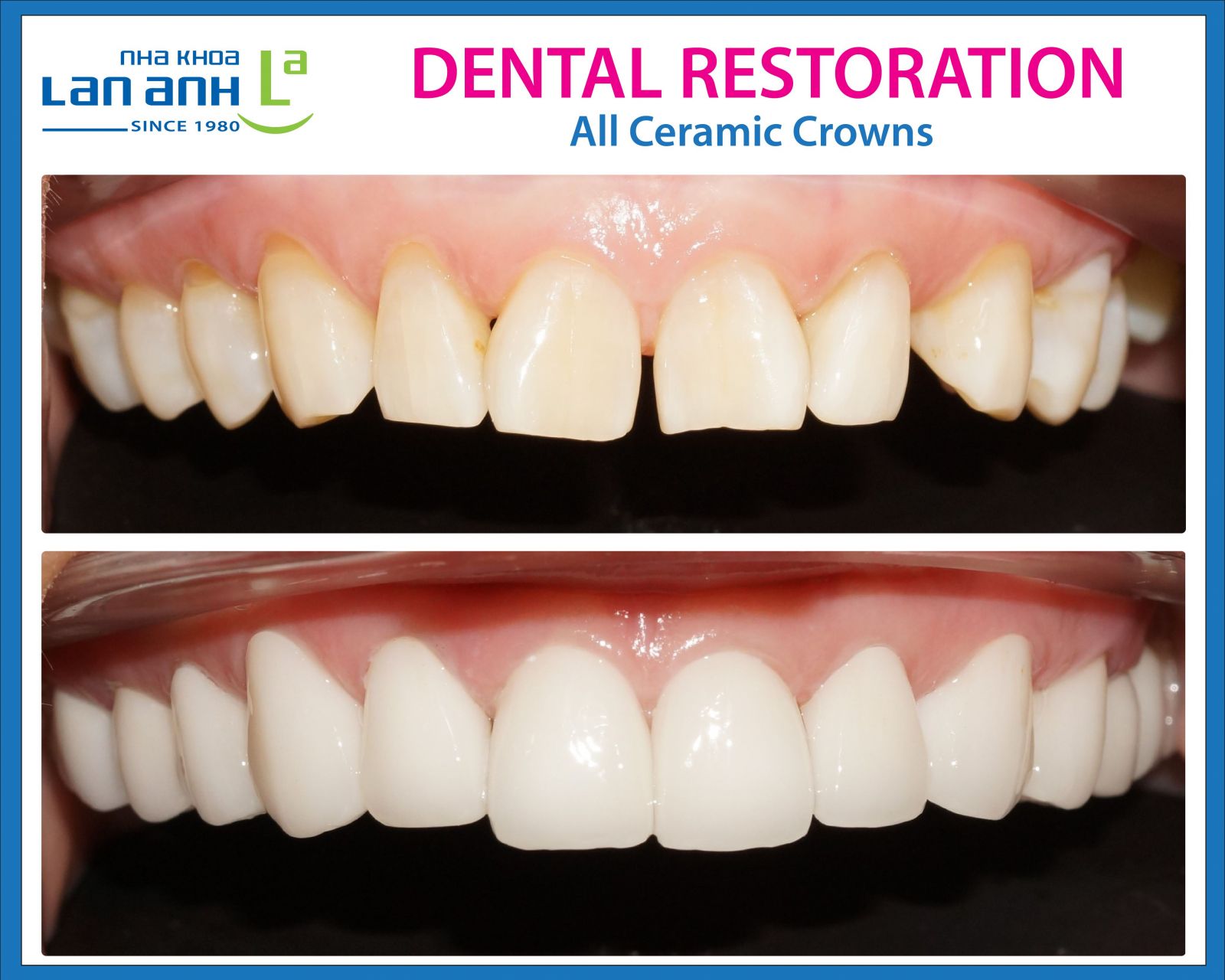 Ceramic Restorations