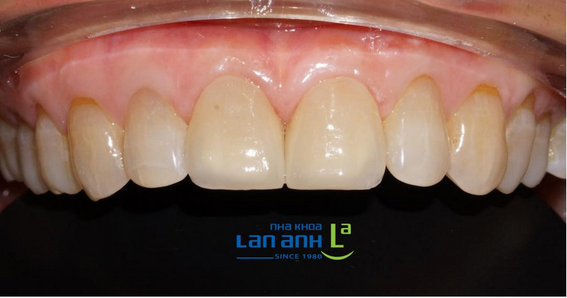 Porcelain Veneers In Just One Day, Is It Possible?