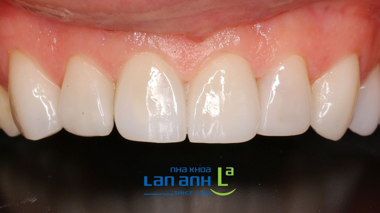 Do You Know What's Different in Premium Porcelain Restorations?