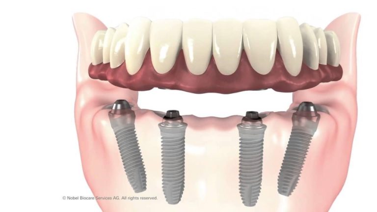 All-On-Four Implants – Full-Mouth Restorations