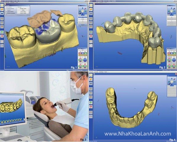Advantages of CAD/CAM Porcelain Restorations (CEREC, Inlab) At Lan Anh Dental Clinic