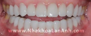 Pictures of Some CEREC Treatment Cases Within The Day With Porcelain Veneers At Lan Anh Dental Clinic