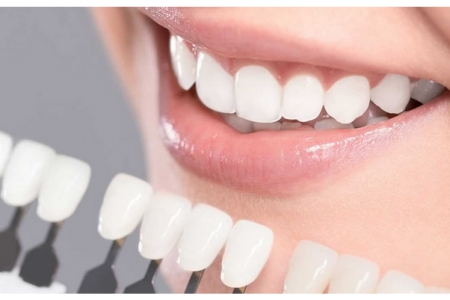 Frequently Asked Questions About Porcelain Restorations