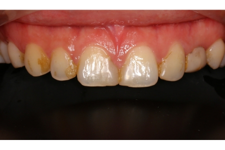 Natural Beauty Of Veneer