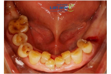 The Best Time to Plan a Dental Implant