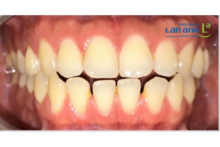 Some Cases of Invisalign treatment