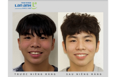 What Do You Care About When Your Children Have Orthodontic Treatment?