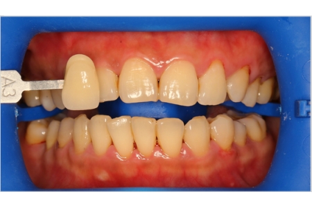 Is Conventional Teeth Whitening As Effective As Teeth Whitening with Philips Zoom Whitespeed