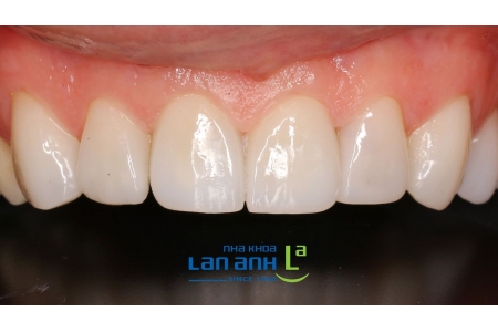 Do You Know What's Different in Premium Porcelain Restorations?