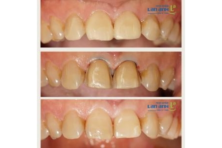 Some Cases of Dental Restorations at Lan Anh Dental Clinic