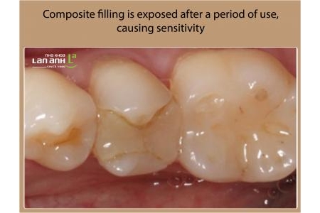 Porcelain Inlay, Modern Dental Filling Techniques with CAD/CAM System